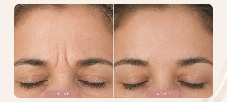 Consultation for Lines & Wrinkles